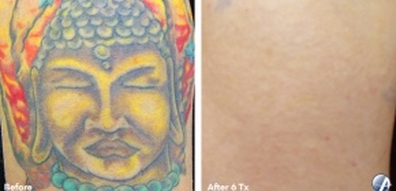 Tattoo removal of full color