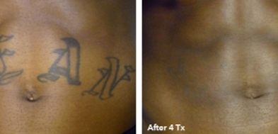 Tattoo removal on dark skin